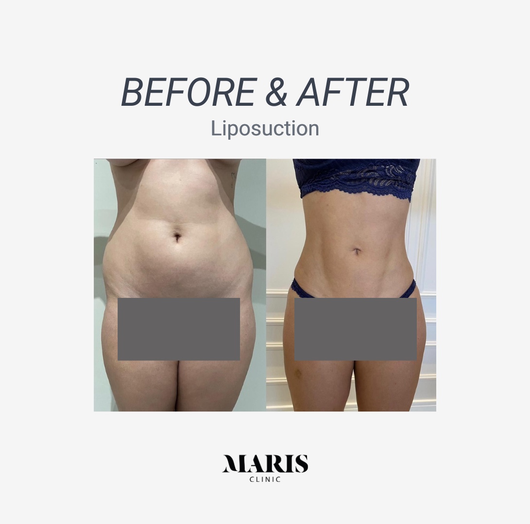 Liposuction HD Dubai